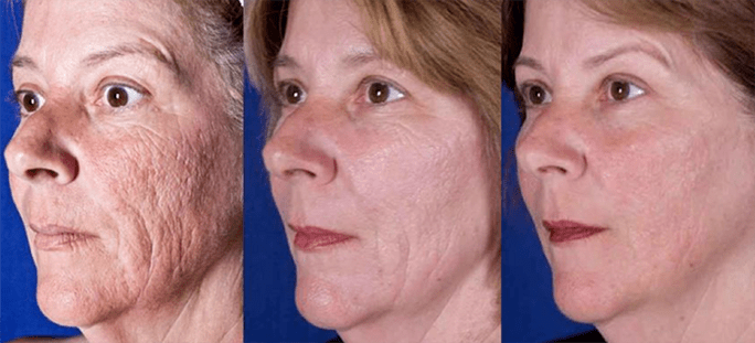 Resultat efter laser ansigtsforyngelsesprocedure