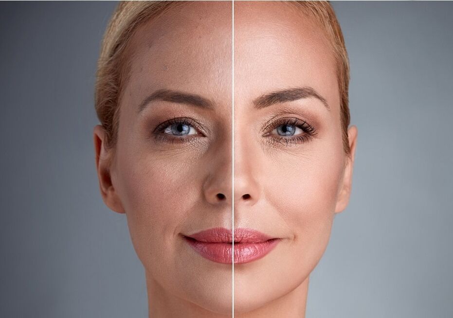 før og efter laser ansigtsforyngelse