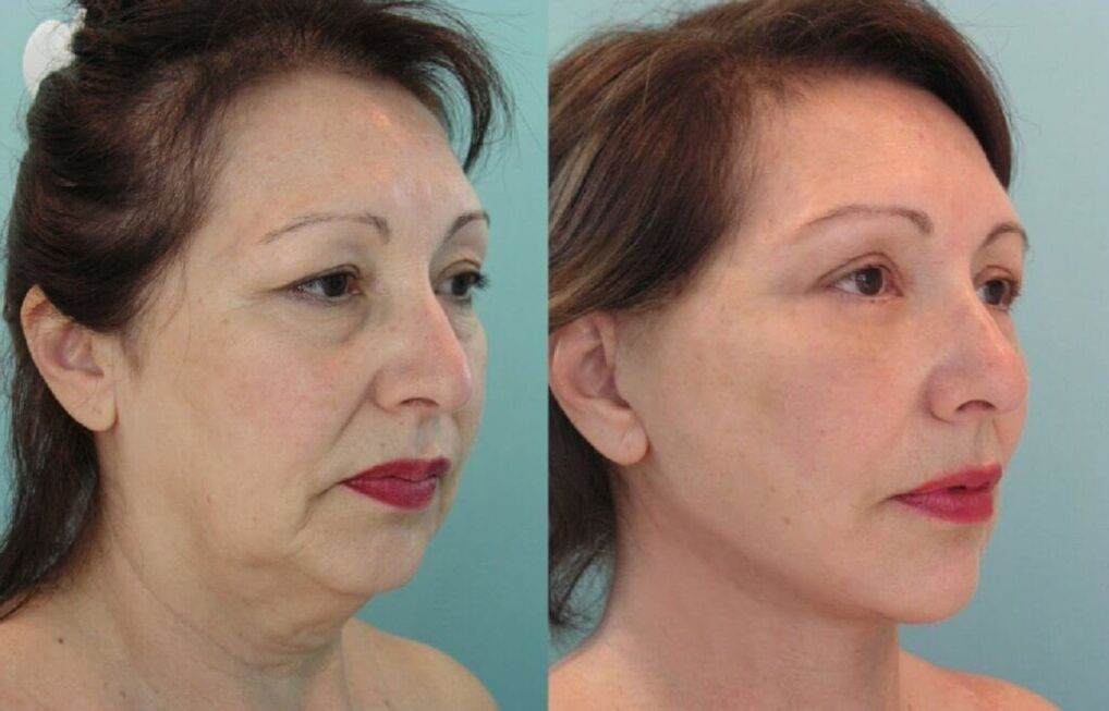 foto før og efter hudforyngelse